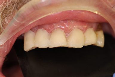 After - Abacus Dental