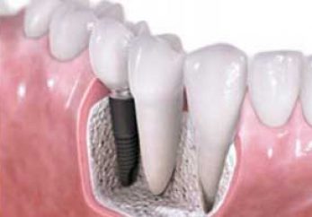 Dental Implants in Milton Keynes