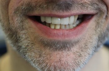 After - Abacus Dental