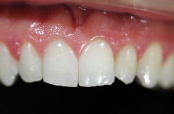 After - Abacus Dental