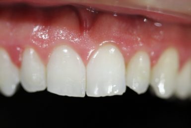 After - Abacus Dental