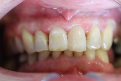 Before - Abacus Dental