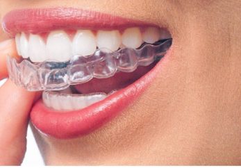 Invisalign Milton Keynes