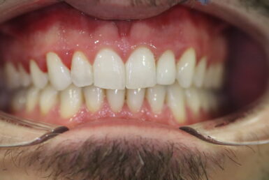 After - Abacus Dental