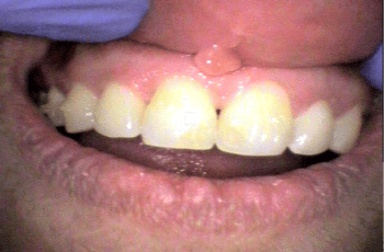 After - Abacus Dental