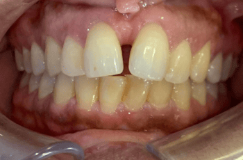 Before - Abacus Dental