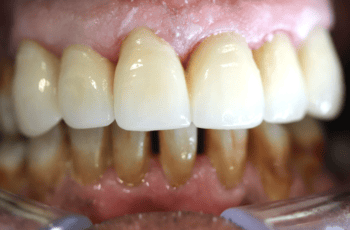 After - Abacus Dental