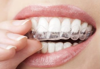 how to use invisalign treatment for a perfect smile