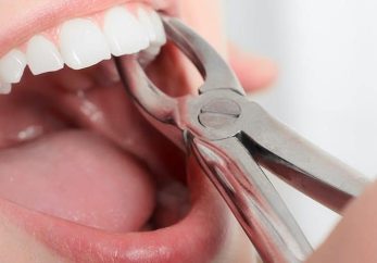 dental extraction at abacus dental in milton keynes