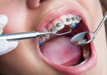 Teeth straightening options at Milton Keynes dentist Abacus Dental Care