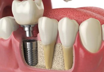 dental implant clinic in milton keynes