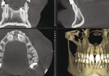 Precicion dental implants in Milton Keynes using CBCT digital imaging