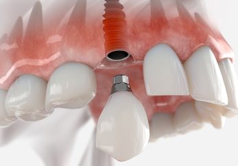 Dental Implant clinic in Milton Keynes