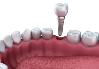 Dental Implant placement in Milton Keynes at Abacus Dental Implant Clinic