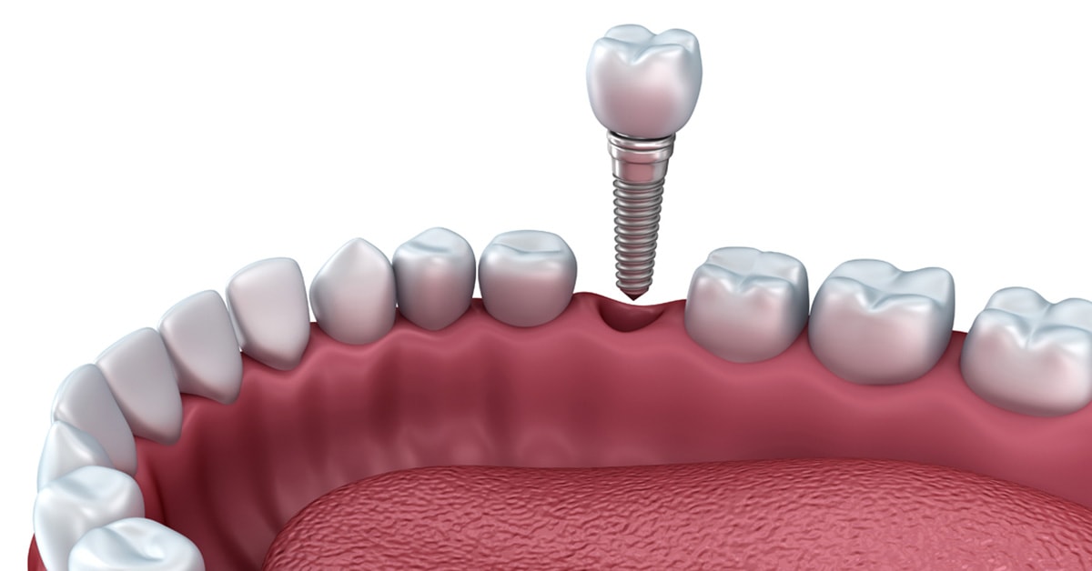 Dental Implant Placement Abacus Dental Care & Implant Clinic