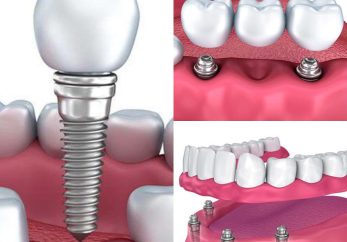 dental implant restorations milton keynes