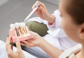 gold standard dental implants milton keynes