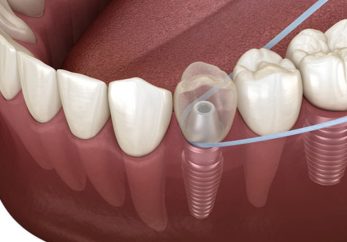 dental implant care guide at milton keynes dentist