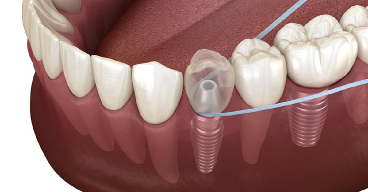 Dental Implant Care Guide Abacus Dental Care & Implant Clinic