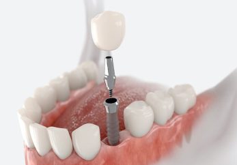 milton keynes dental implant investment information
