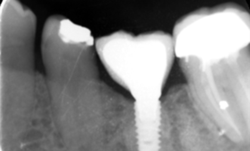 After Xray -Abacus Dental