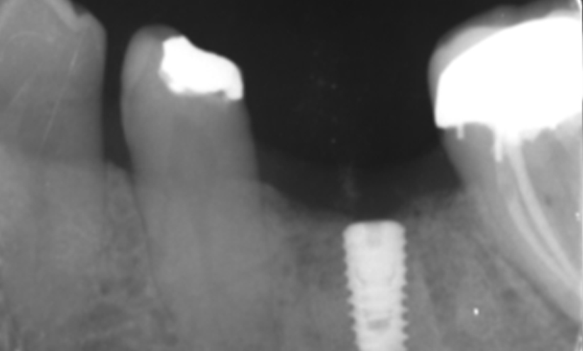 Before Xray - Abacus Dental