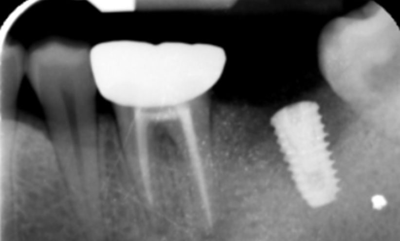 After Xray -Abacus Dental