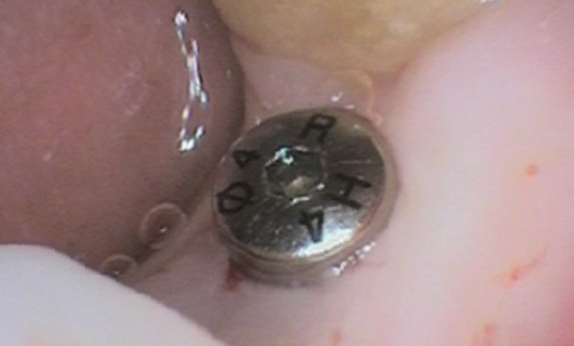 Before Xray - Abacus Dental