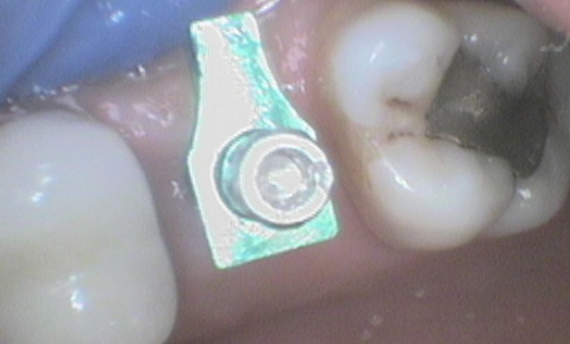 After Xray -Abacus Dental