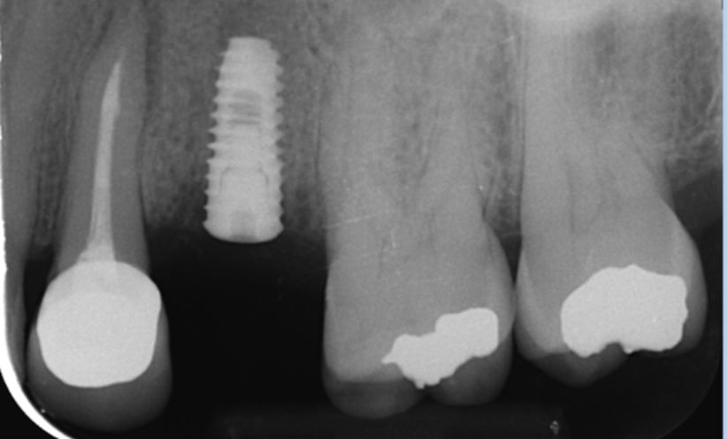 Before Xray - Abacus Dental