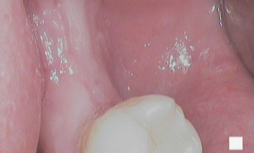 After Xray -Abacus Dental