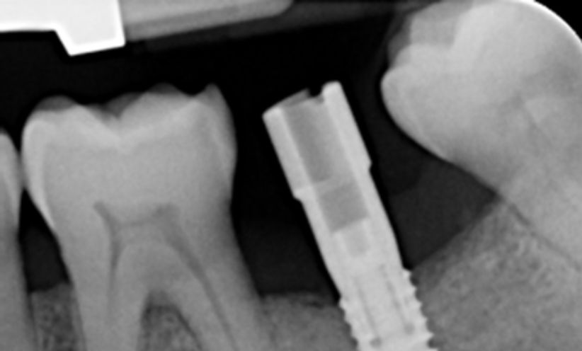 Before Xray - Abacus Dental