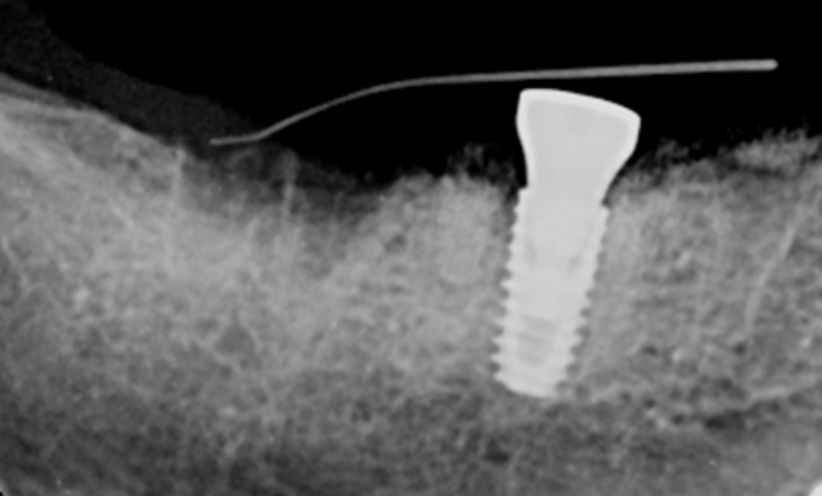 Before Xray - Abacus Dental