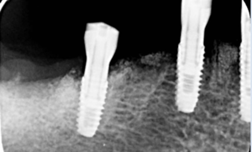 Before Xray - Abacus Dental