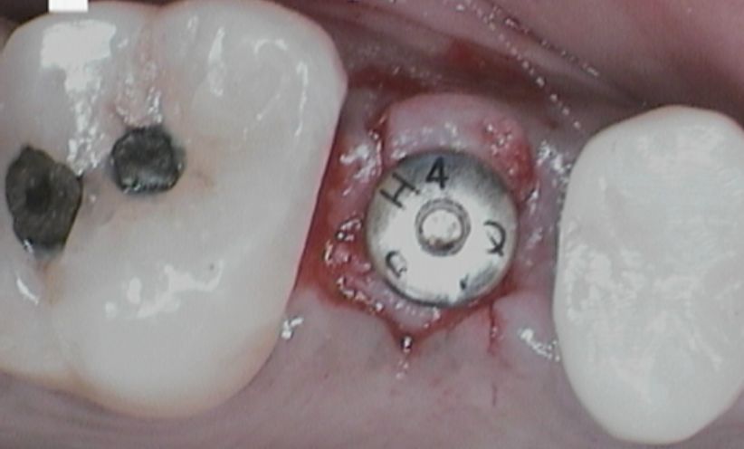 After Xray -Abacus Dental