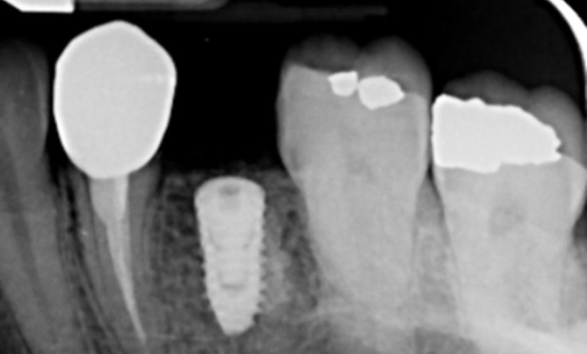 Before Xray - Abacus Dental