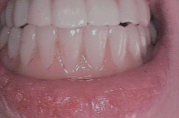 After - Abacus Dental