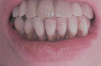 Before - Abacus Dental