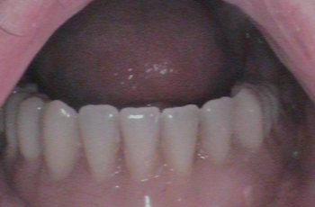 After - Abacus Dental