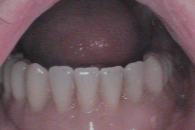 After - Abacus Dental
