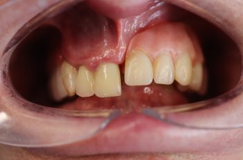 Before - Abacus Dental