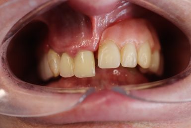 Before - Abacus Dental