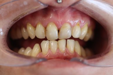 Before - Abacus Dental