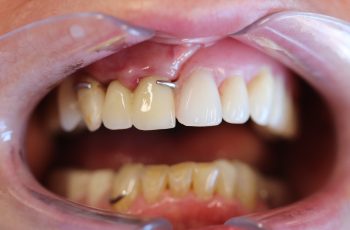 After - Abacus Dental