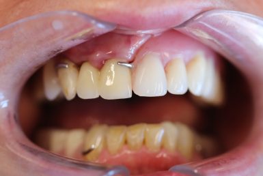 After - Abacus Dental