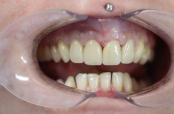 After - Abacus Dental