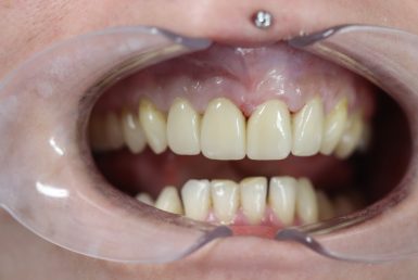 After - Abacus Dental