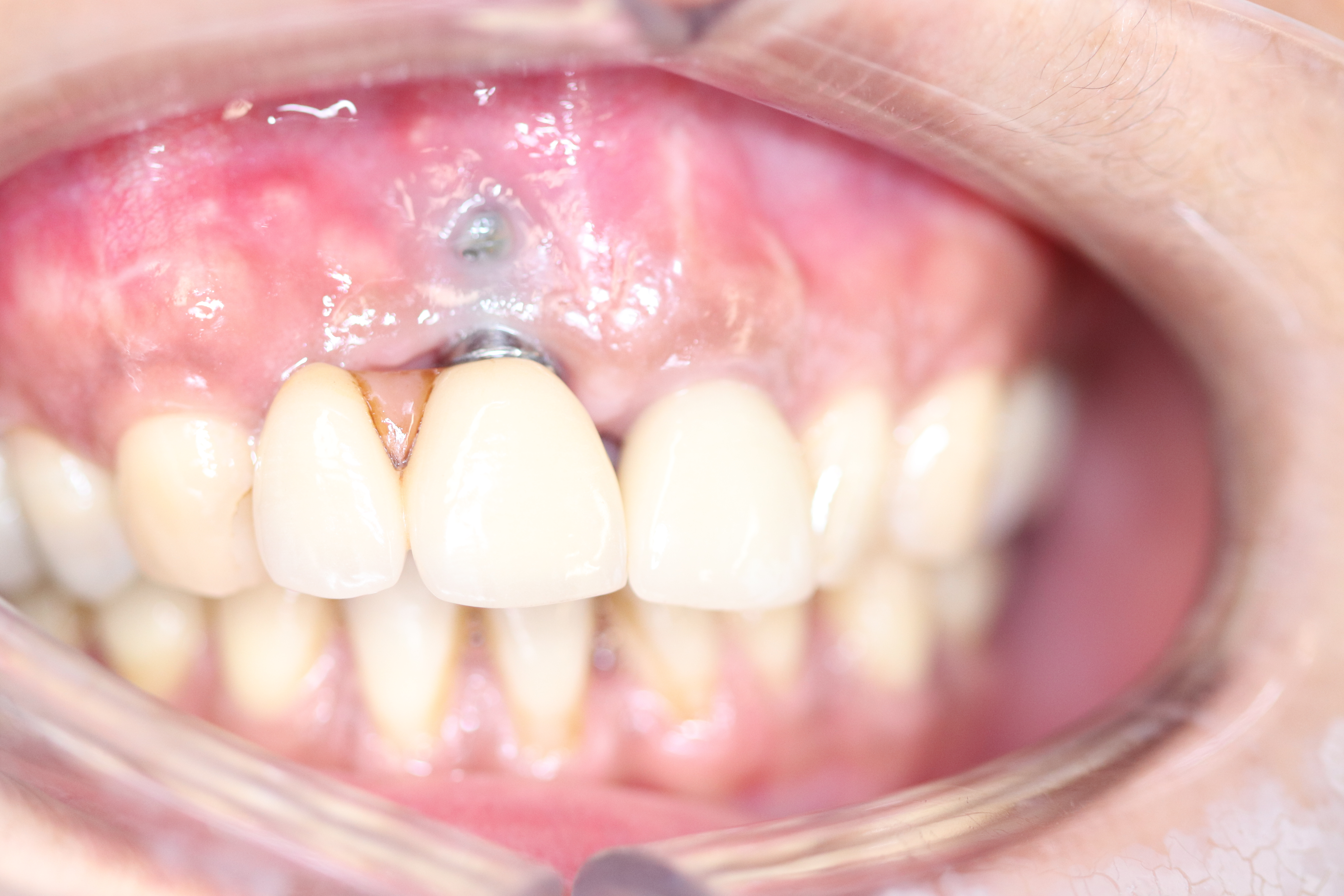 Before - Abacus Dental