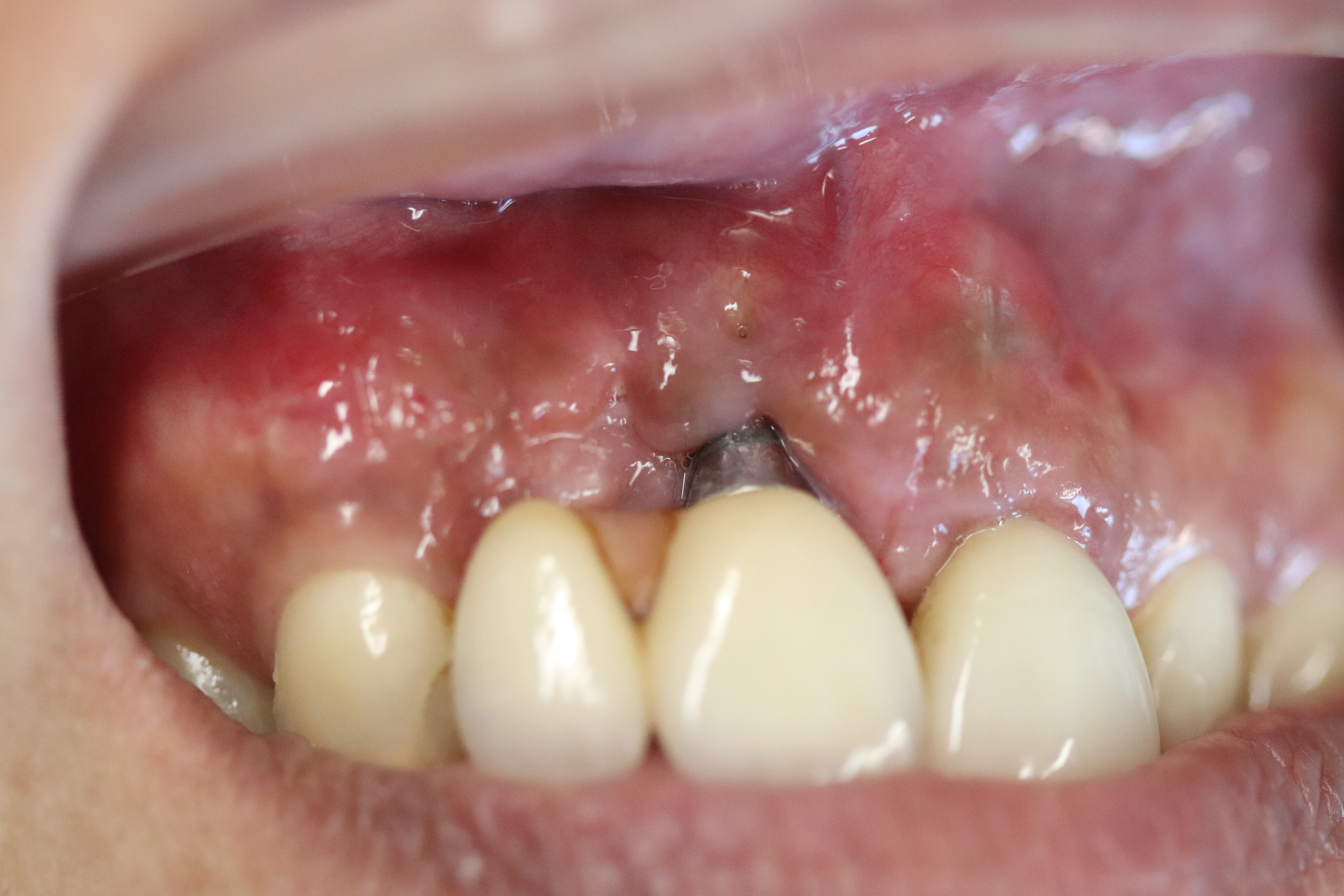 After -Abacus Dental