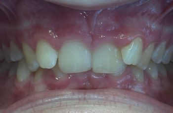 Before - Abacus Dental